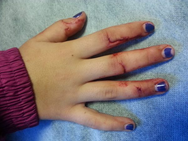 La importancia de los guantes. El caso de Nahia (9 años) - Noticias -  Nevasport.com